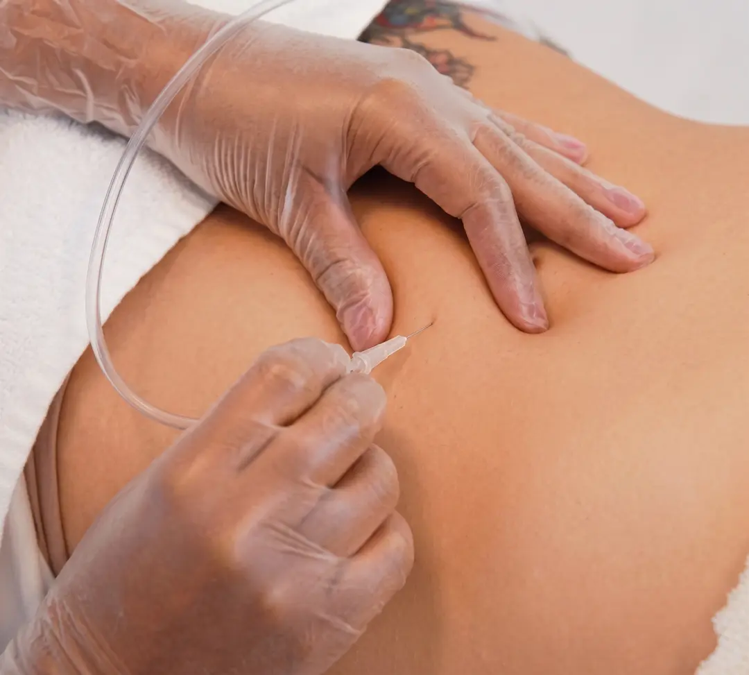 Carboxiterapia