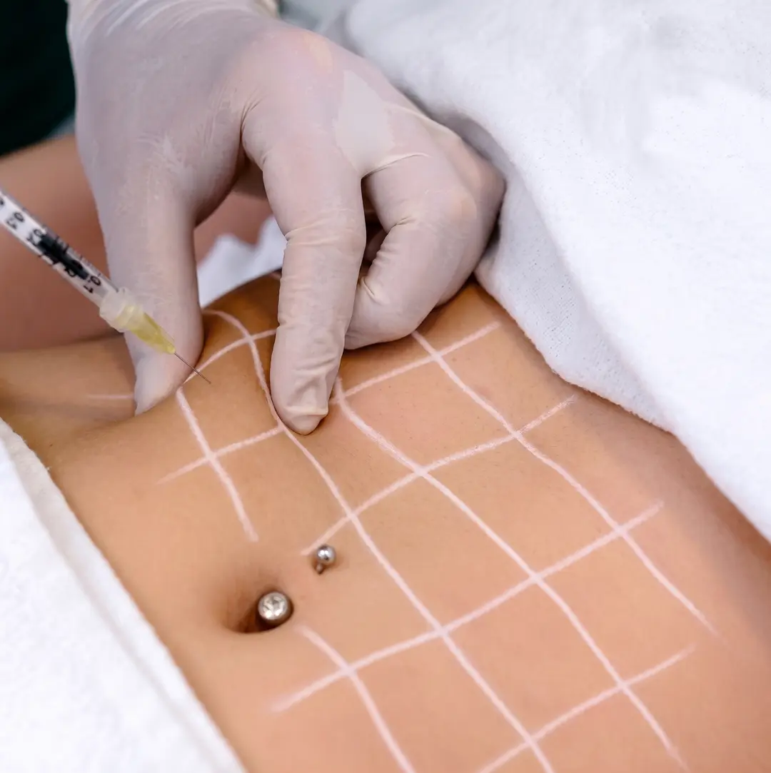 Mesoterapia Corporal
